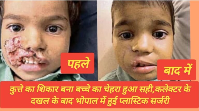 कुत्ते का शिकार बना बच्चे का चेहरा हुआ सही,कलेक्टर के दखल के बाद भोपाल में हुई प्लास्टिक सर्जरी
